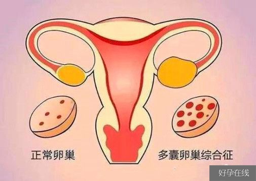 正常卵巢与多囊卵巢综合征的区别