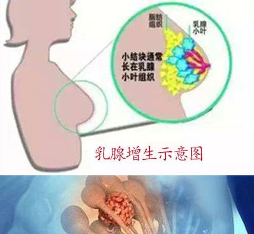 乳腺增生有什么危害