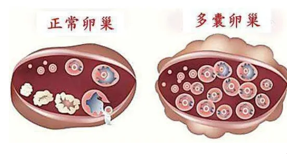 正常卵巢和多囊卵巢的区别