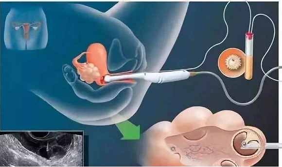 精子卵子将直接影响到试管婴儿成功率