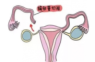 湖北慈铭博鳌国际医院三代试管婴儿，切除双侧输卵管还能做试管婴儿吗？